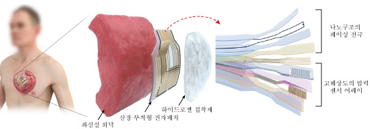 IBS 나노의학연구단이 개발한 '심장 부착형 패치형 기기' 개념도로, 부정맥을 실시간으로 진단하면서 동시에 치료해 준다.  IBS 제공